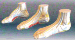 足弓模型（正常足、平板足、弓形足）